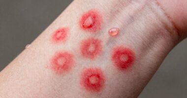 cold induced skin allergy