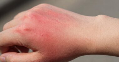 cold induced skin redness