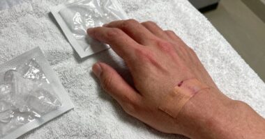 post op cold exposure caution